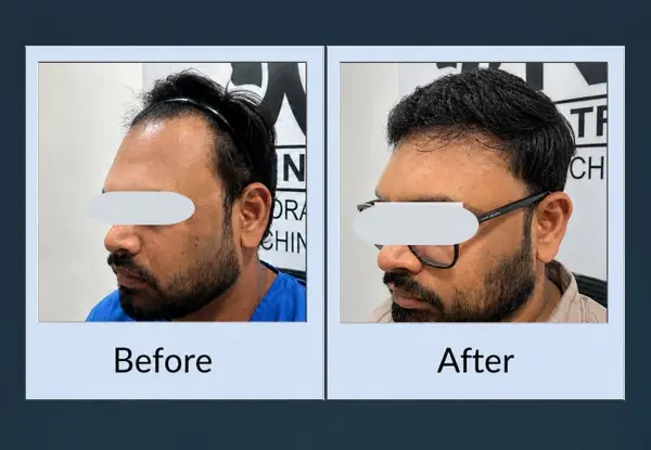 Hair transplant before and after, three-quarter view: a receded hairline with thinning above the temple, then restored density along the whole hairline.