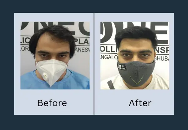 Hair transplant before and after, front view: recession at both temples leaving a narrow central tuft, then an even, fully restored hairline.