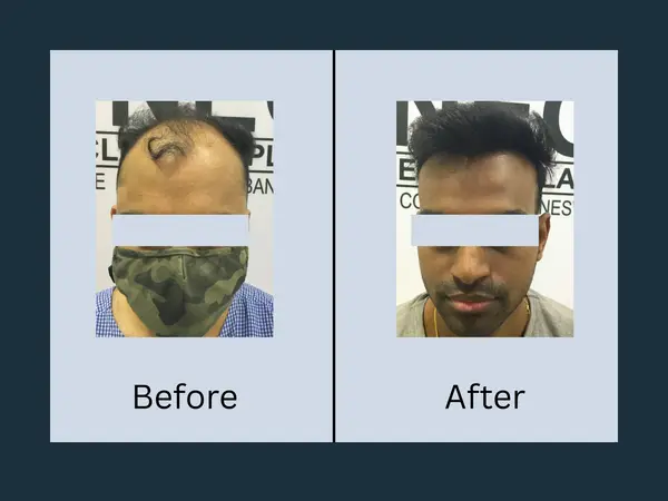 Hair transplant before and after: extensive baldness across the front and mid-scalp with only a small forelock remaining, then thick hair with a rebuilt hairline.