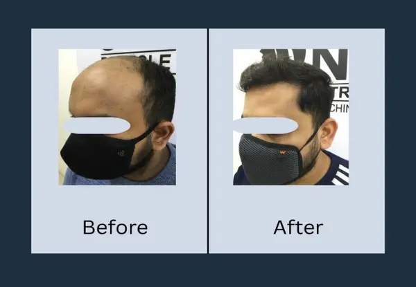 Hair transplant before and after, profile view: a bare frontal scalp above the temple, then restored hair framing the side of the hairline.