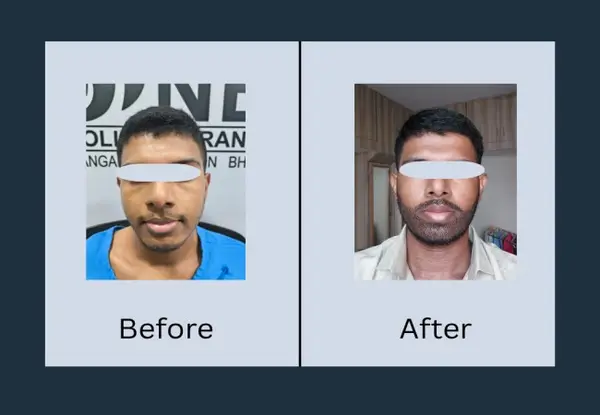Hair transplant before and after, front view: a receded hairline with sparse frontal hair, then a lowered hairline with visible density.