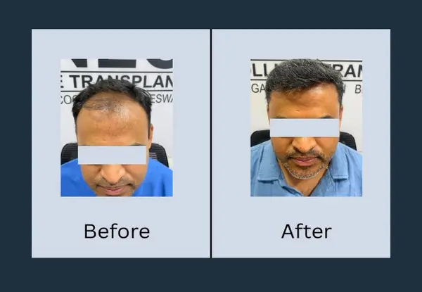 Hair transplant before and after: diffuse thinning across the front and mid-scalp with the scalp showing through, then noticeably denser coverage.