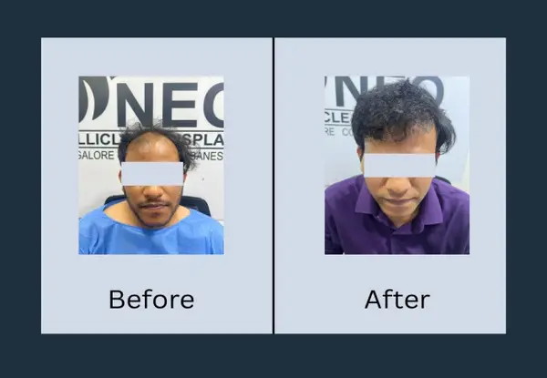 Hair transplant before and after seen from above: a thin, see-through frontal scalp, then thick dark hair covering the same area.