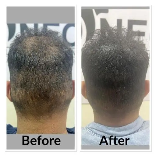 Scalp micropigmentation before and after, back of the head: a thinning crown with the scalp showing through short hair, then an even, solid appearance of density.