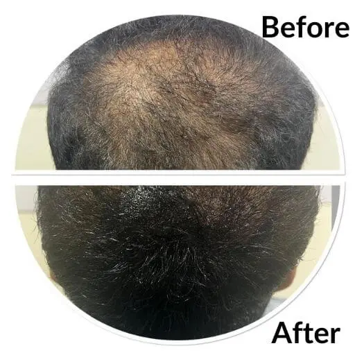 Before and after over the crown: a wide thinning area with the scalp clearly visible, then noticeably fuller coverage.
