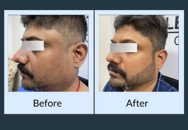 Before and after patchy beard correction at Neo Follicle.