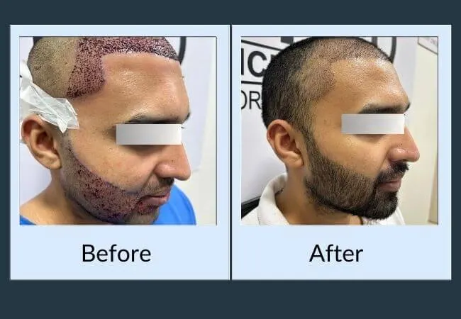 Before and after moustache and goatee restoration at Neo Follicle.