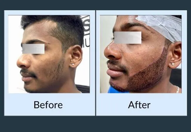 Before and after facial hair restoration at Neo Follicle.