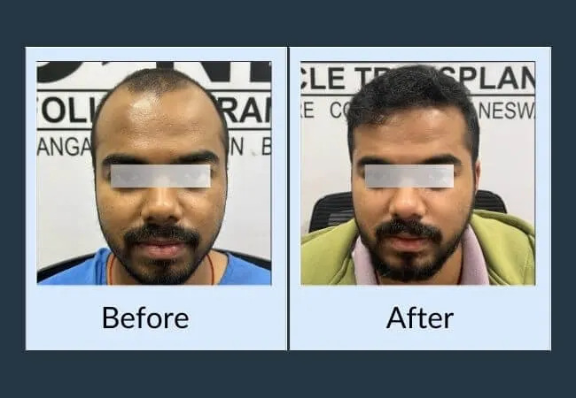 Before and after hairline restoration at Neo Follicle.