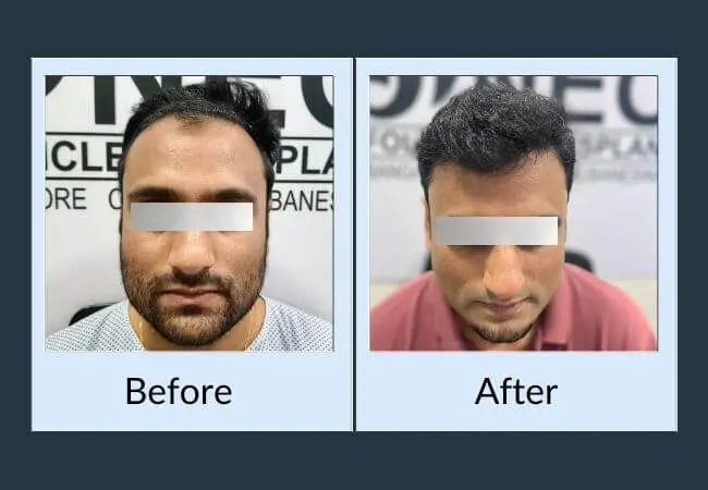 Before and after crown density restoration at Neo Follicle.