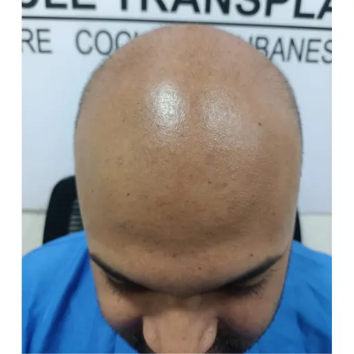 Body hair assessed as a donor source at Neo Follicle.