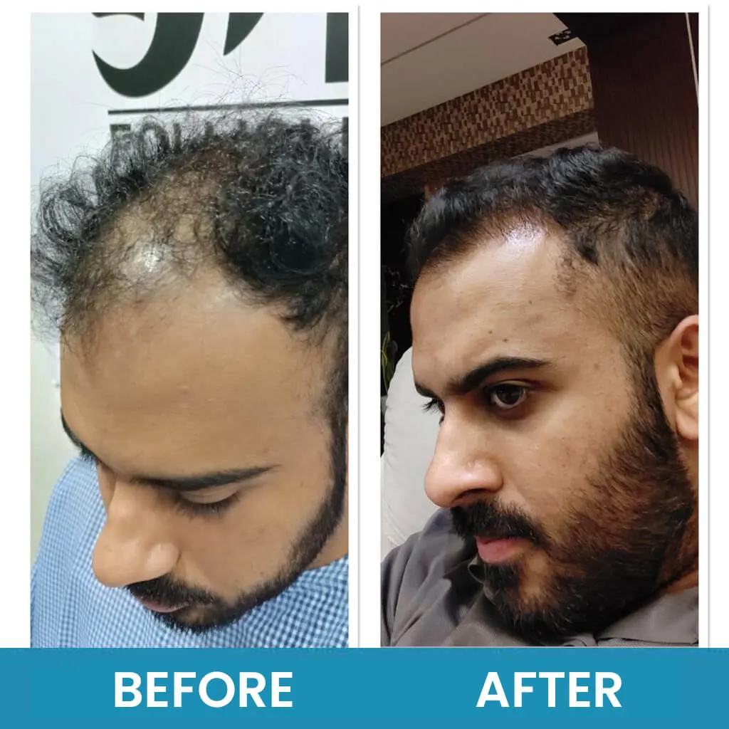 Before and after exosome therapy at Neo Follicle.