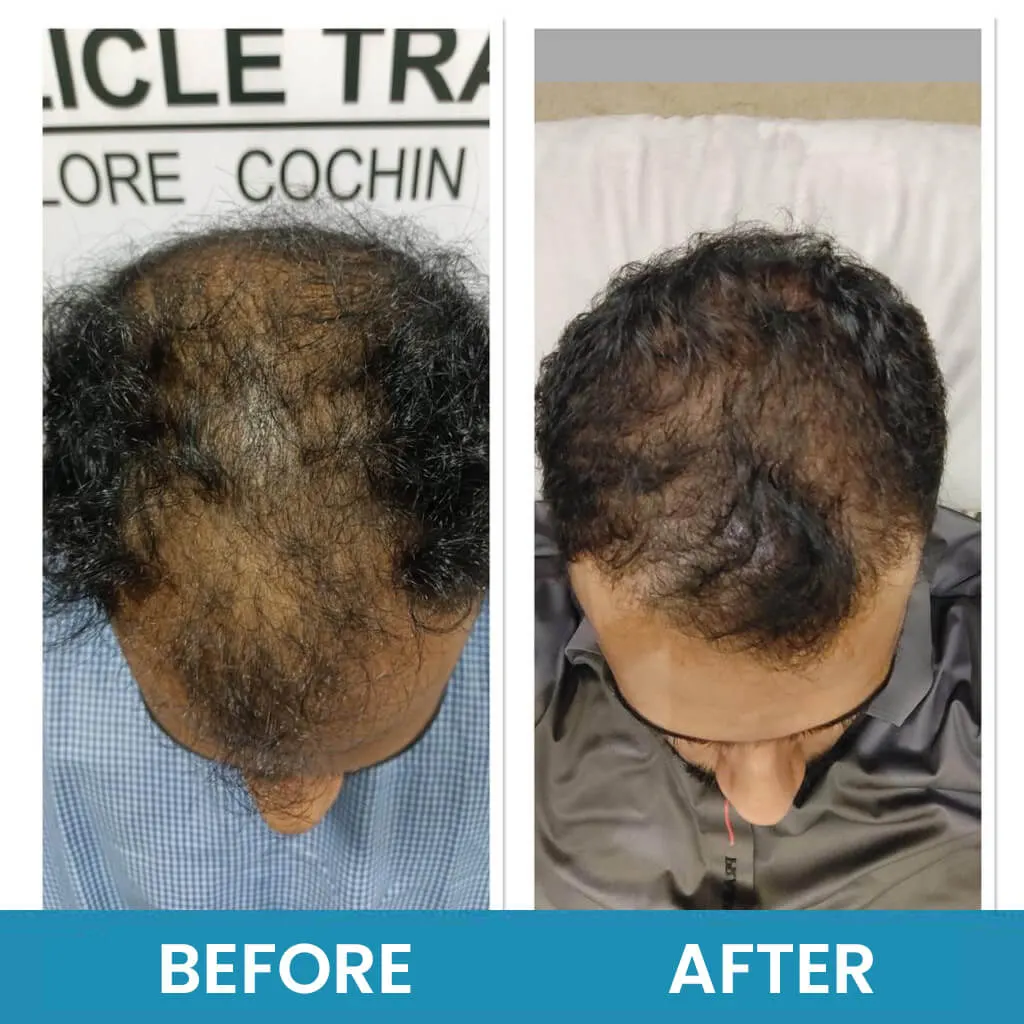 Before and after exosome therapy showing improved density at Neo Follicle.