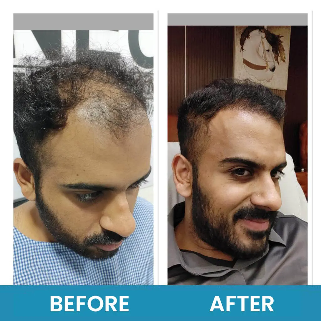 Before and after exosome therapy across the crown at Neo Follicle.