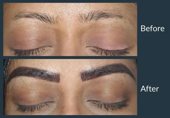 Before and after restoring over-plucked eyebrows at Neo Follicle.