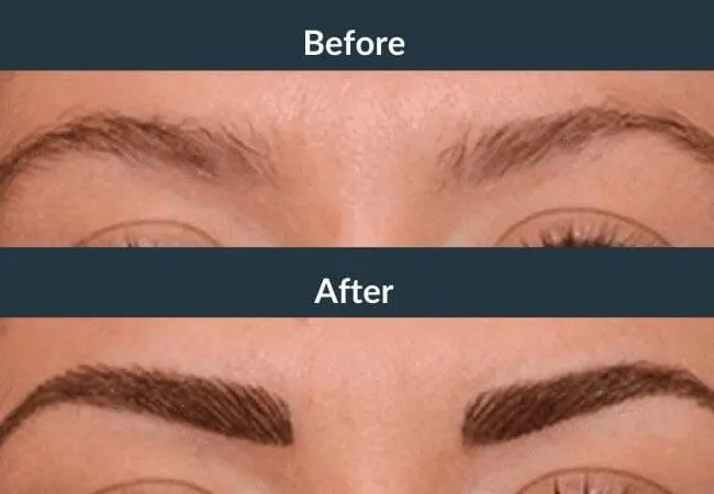 Before and after eyebrow density restoration at Neo Follicle.
