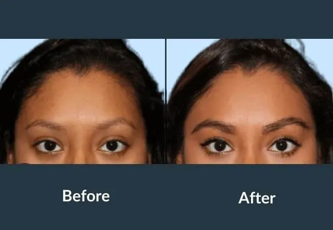Before and after eyebrow shaping and restoration at Neo Follicle.