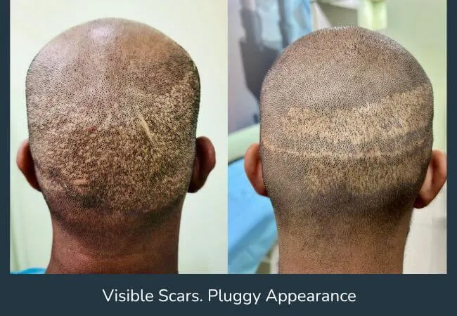 A previous hair transplant showing poor density before corrective planning.