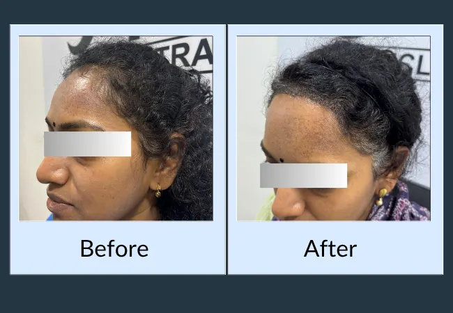 Before and after female hairline restoration at Neo Follicle.