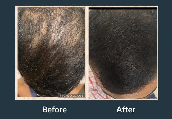 Before and after GFC therapy showing improved density at Neo Follicle.