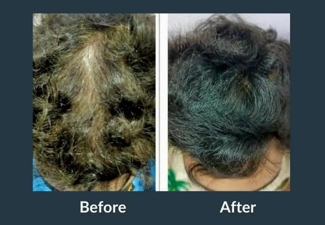 Before and after GFC therapy across the crown at Neo Follicle.