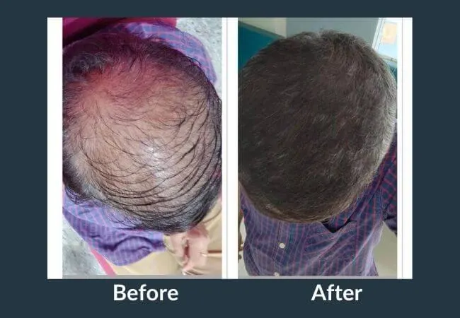 Before and after GFC therapy along the hairline at Neo Follicle.