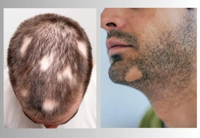 A round patch of hair loss on the scalp, characteristic of alopecia areata.