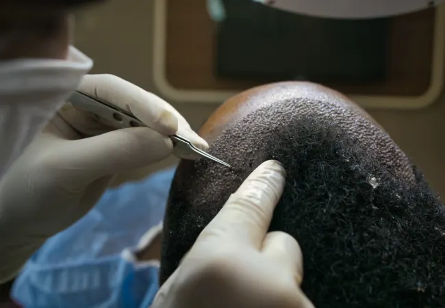 An unnatural hairline from a previous hair transplant, before repair.