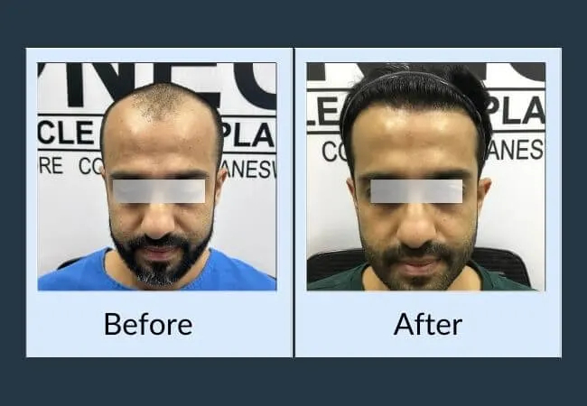 Before and after a hair transplant at Neo Follicle.