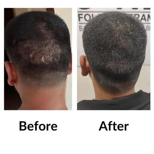 Before and after scalp micropigmentation across the crown at Neo Follicle.
