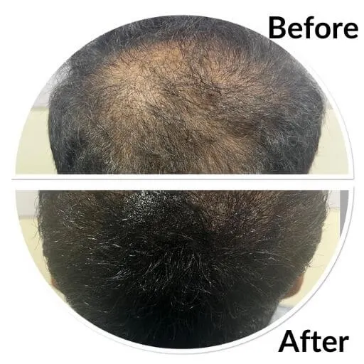 Before and after scalp micropigmentation along the hairline at Neo Follicle.