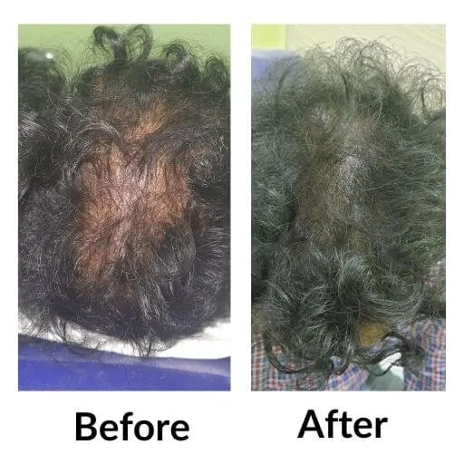 Before and after scalp micropigmentation showing denser coverage at Neo Follicle.