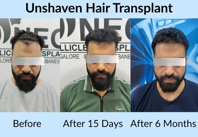Before and after an unshaven hair transplant at Neo Follicle.