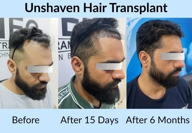 Before and after unshaven hairline restoration at Neo Follicle.