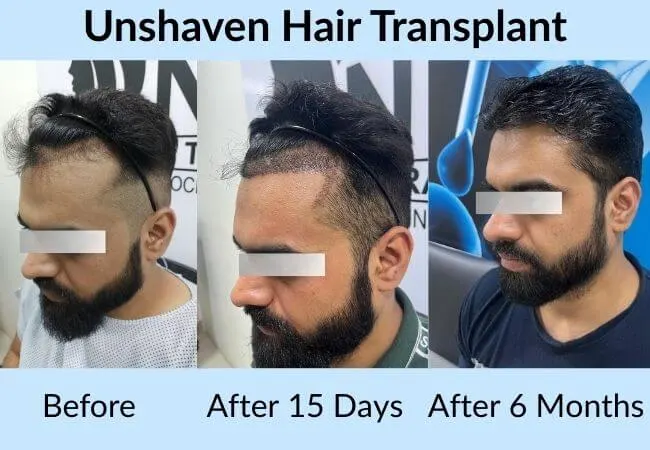 Before and after an unshaven procedure with minimal visible change.