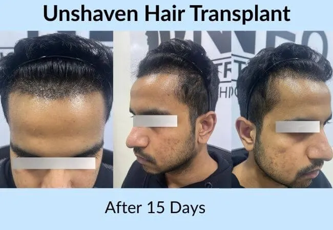 An unshaven hair transplant fifteen days after the procedure.