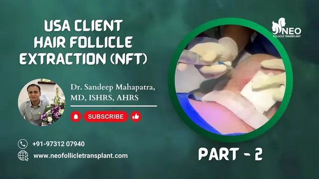 Best hair transplant surgeon in India | Follicular Unit Extraction | Hair Extraction for US client