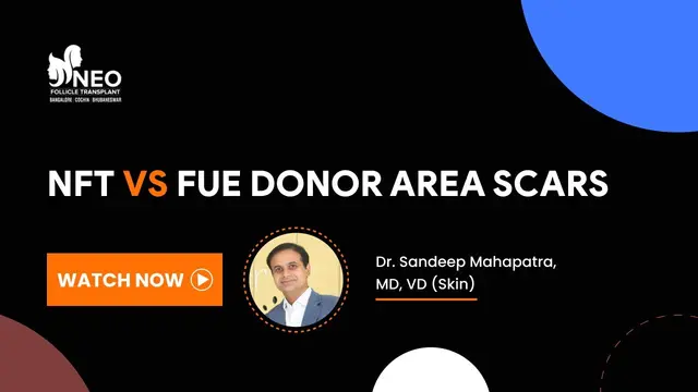 NFT v/s FUE Donor Area Scars | Advanced FUE Hair Transplant | Donor Area Scars