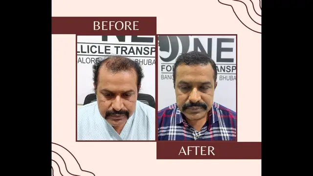 Best hair transplant in Bangalore | Hair fixing in Bangalore | Patient's Testimonial