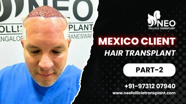 Best Hair Transplant Bangalore India | Hair Transplant consultant | best hair transplant results.