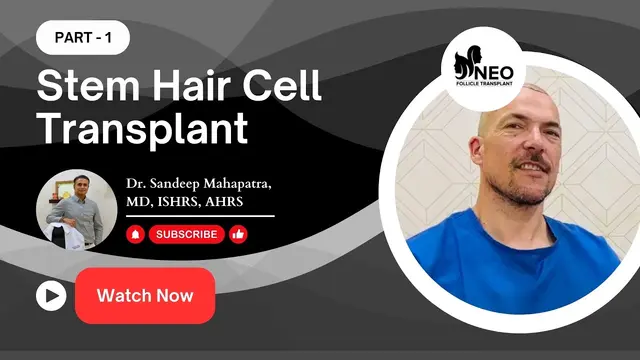 Stem Cell Hair Transplant | Hair Transplant cost in India | Stem cell Transplant | Best hair surgeon