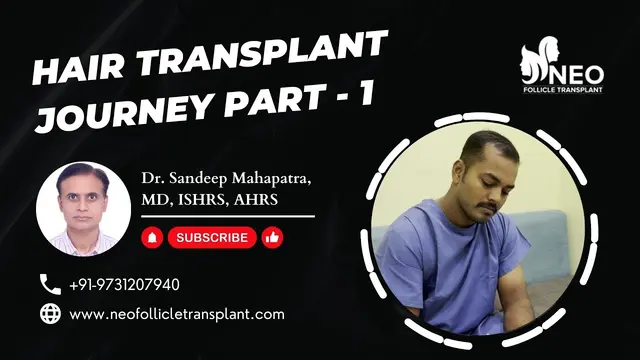 Unbelievable Hair Transformation | Hair Transplant in Bangalore | Hair Transplant Cost India | NFT