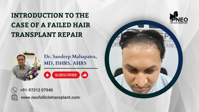 Failed Hair Transplant Repair | #failedhairtransplant | #hairtransplantation | NEO Follicle