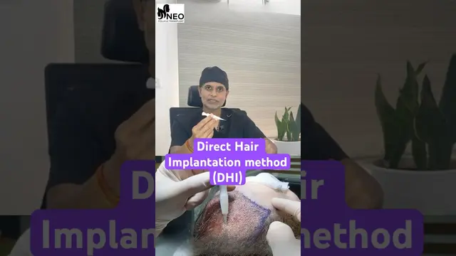DHI Direct Hair Implantation Explained | Advanced Hair Transplant in Bangalore! #FUE #DHI #clinic