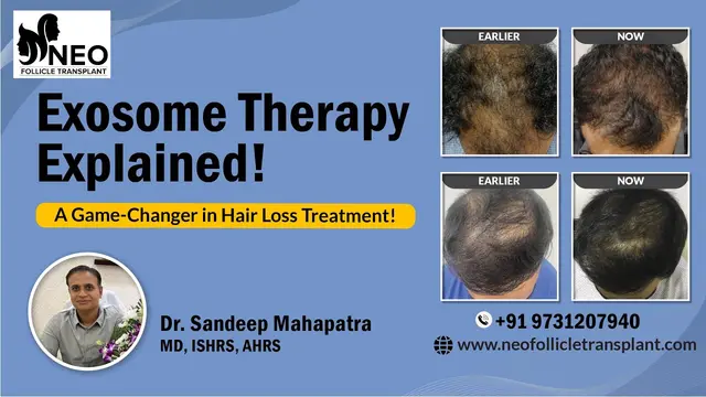 Exosome Therapy for Hair Thinning | Advanced Hair Loss Solution Explained by Dr. Sandeep Mahapatra.