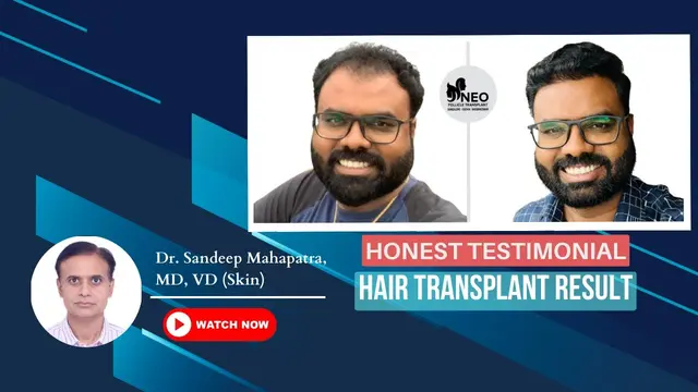 Best Hair transplant in Bangalore| Hair transplant result | #hairtransplantresults