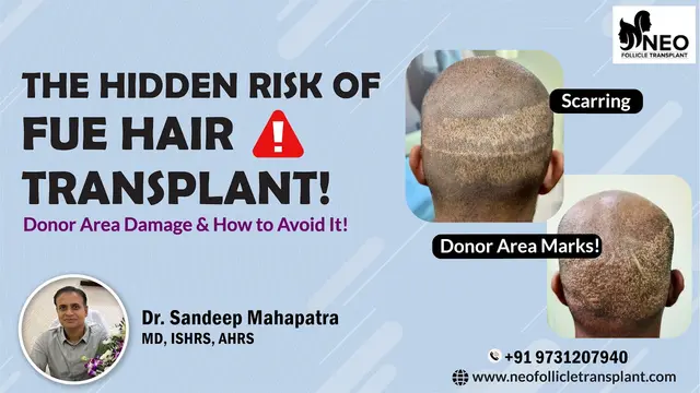 Can FUE Hair Transplant Damage the Donor Area? | Dr. Sandeep Mahapatra from Neo Follicle Explains!