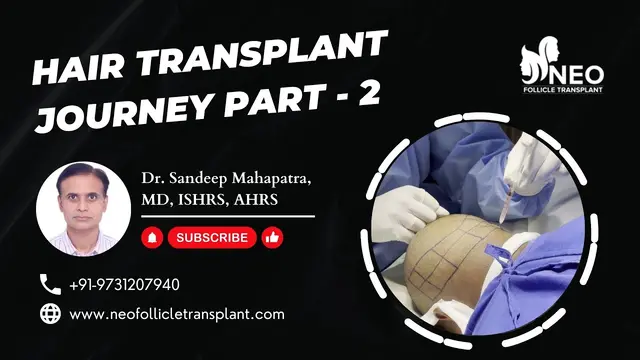 Part 2 Extraction of Grafts | Hair Transplant Journey | Neo Follicle Hair Transplant Bangalore