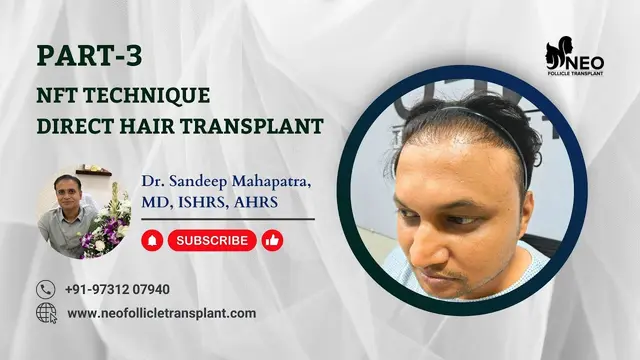Direct Hair Transplant | Direct Hair Transplant Procedure | NFT Technique by Dr. Sandeep Mahapatra