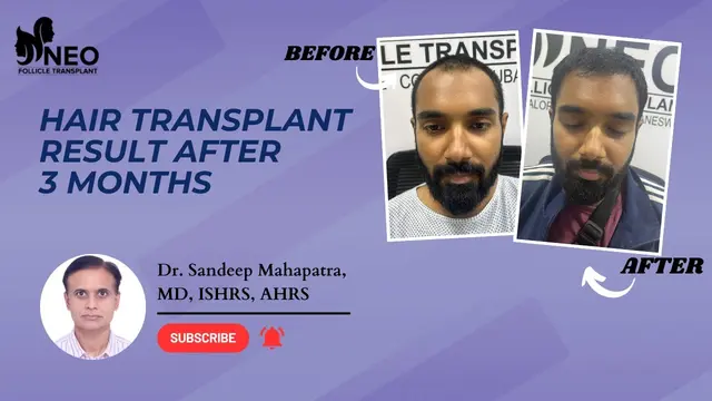 Best Hair Transplant | Hair Transplant in Bangalore | Hair Transplant Results Before and After